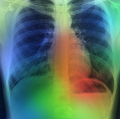 After installing a lung nodule detection AI platform