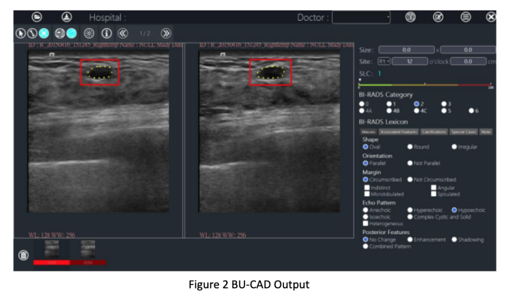 The addition of TaiHao Medical's BU-CAD™ for diagnostic ultrasound exams expands the Ferrum Enterprise AI Platform and provides radiologists with another tool in the fight against cancer.